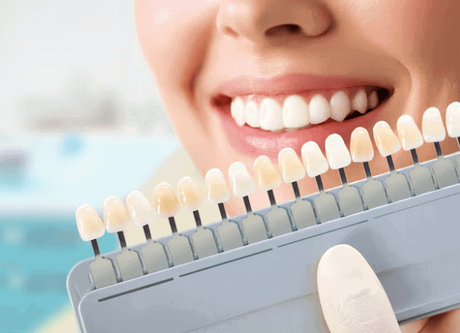 Does Insurance Cover Veneers: Is it True?